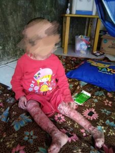 Ringankan Biaya Pengobatan, DPP IMMAN  Galang Dana Untuk Kesembuhan Balita Penderita Penyakit Kulit