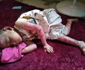 Sejak Lahir, Balita Asal Madina Derita Penyakit Aneh