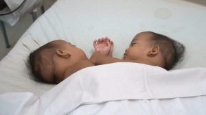 Adam Dan Haris Bayi Kembar Siam Asal Labuhanbatu Dioperasi