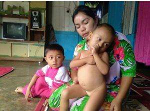 Cerita Pilu Orang Tua Balita Kurang Gizi di Sidimpuan: Tak Punya Uang Bayar Tunggakan BPJS