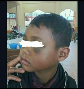 Miris! Bocah 9 Tahun di Madina Dianiaya Orang Gangguan Jiwa