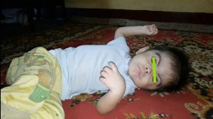 Derita Penyakit Hipotiroid, Kulit Balita di Sidimpuan ini Jadi Bersisik, Jika Disisir Keluar Darah