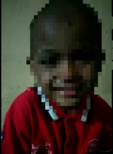 Biadab! Nyaris Seluruh Tubuh Balita Asal Paluta ini Dibakar Ayah Kandung dan Ibu Tiri Pakai  Anti Nyamuk?