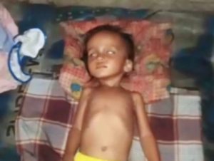 Tiga Pekan Dirawat di RSUD Sidimpuan, Balita “Gizi Buruk” Meninggal Dunia