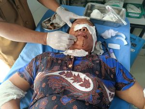 Gegara Sengketa Lahan, Wanita di Madina Disiram Air Keras