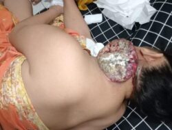 Leher Membusuk Dipenuhi Ulat, RS H Adam Malik Tak Prioritaskan Pasien Asal Padangsidimpuan