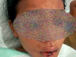 Ketika Cinta Tak Diterima, Siswi SMP Disiram Air Keras oleh Sepupu Sendiri