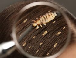 Catat! Ini Cara Menghilangkan Kutu di Kepala Anda