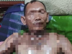 Beredar Foto Penuh Luka Bakar Oknum Sekdes di Sidimpuan Terduga Pembakar Selingkuhannya